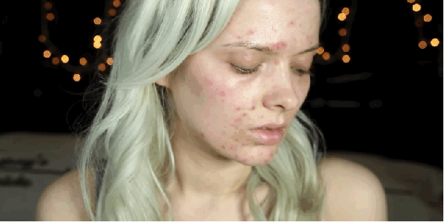 tratar pieles con acne
