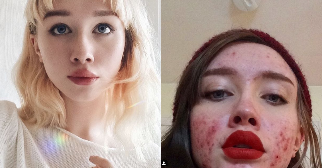 instagramer muestra su acne