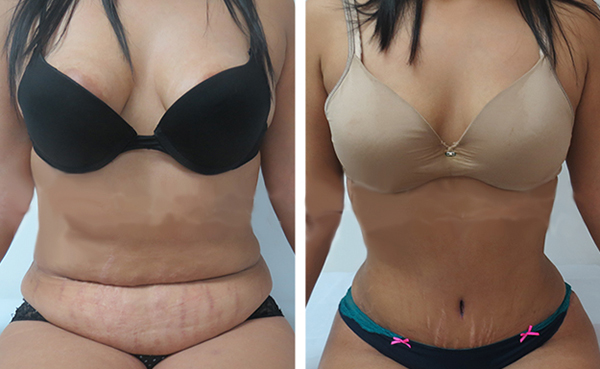 tratamientos esteticos para perder barriga