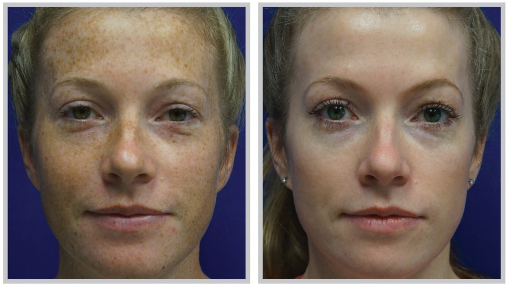 tratamientos esteticos para la cara tratamientos esteticos para la cara