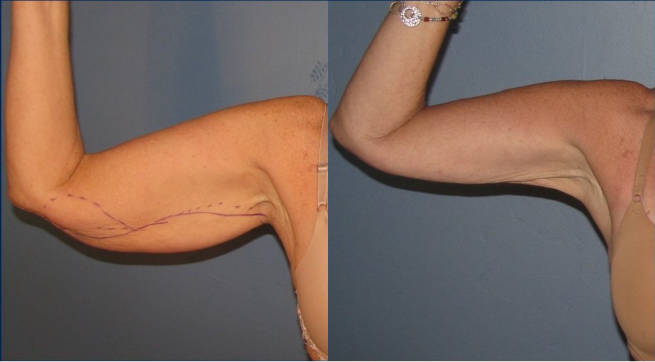 tratamientos esteticos brazos