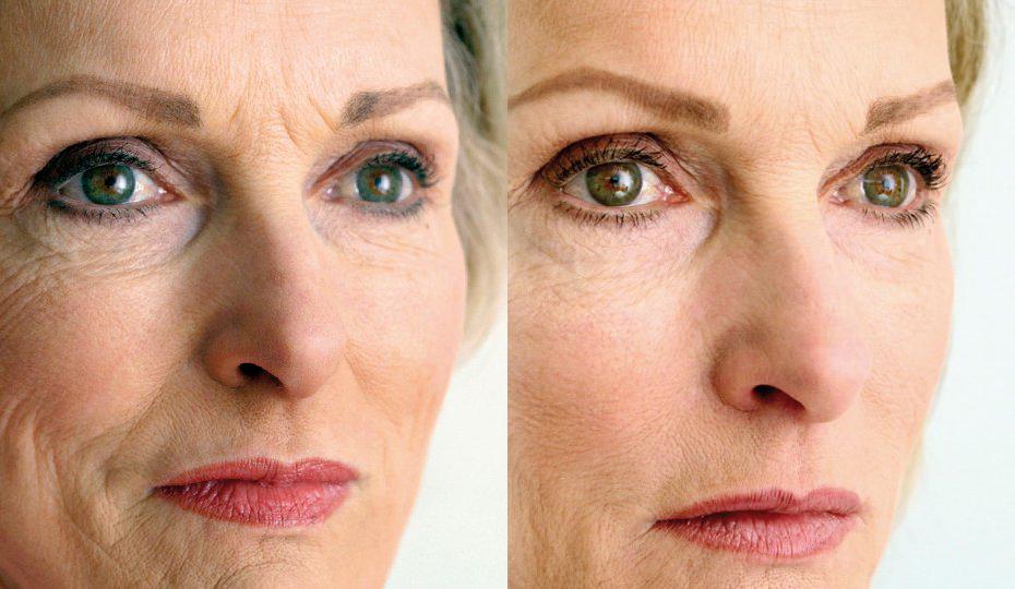 acido hialuronico en tratamientos de belleza 