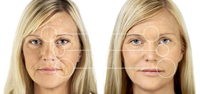 acido hialuronico en tratamientos de belleza 