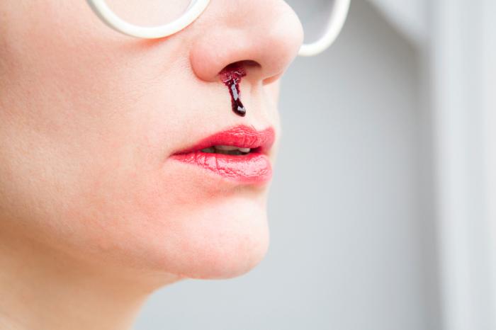 Qué hacer cuando te sangra la nariz