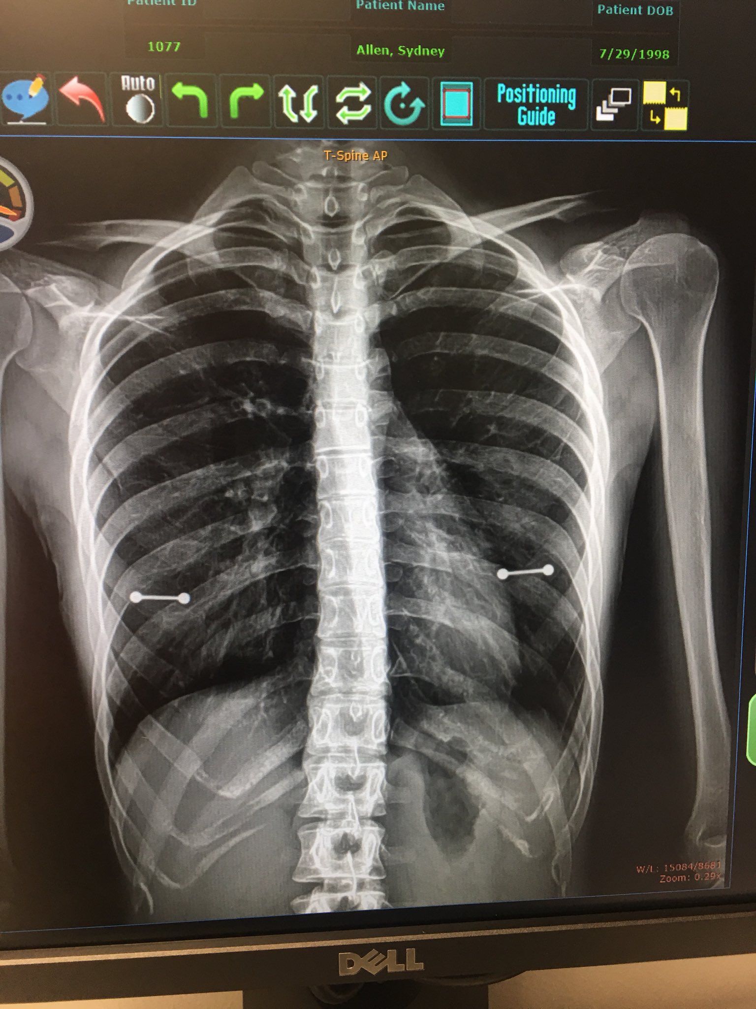 Madre encuentra piercings en los pezones de su hija