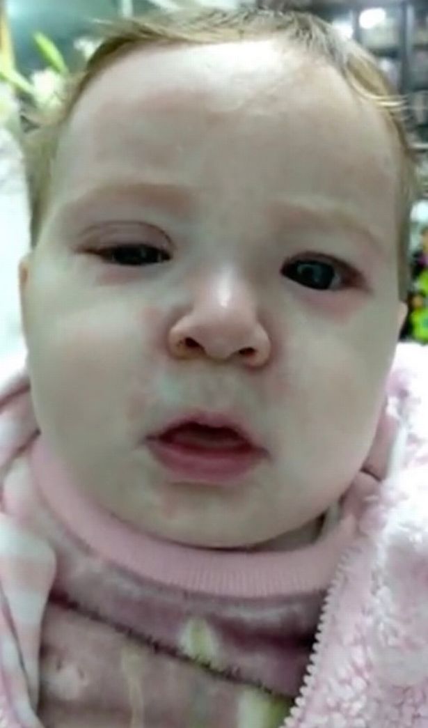 Publica fotos de su hija muy enferma de SARAMPIÓN para denunciar a los ANTIVACUNAS