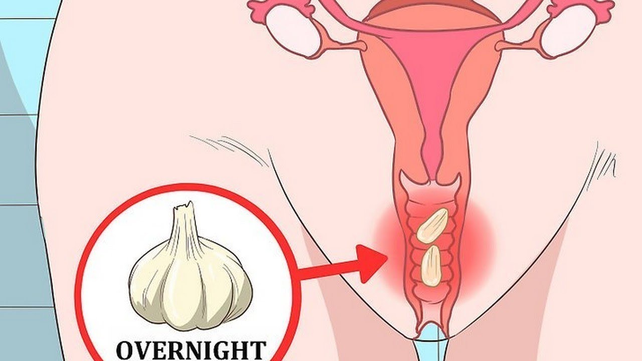 La verdadera razón por la que las mujeres se meten ajos en la vagina 