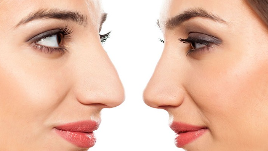 rinoplastia ultrasónica