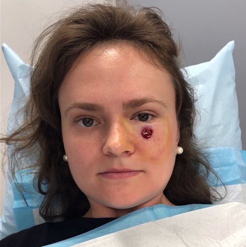 Esta mujer pensó que tenía un grano bajo el ojo, pero resultó ser cáncer de piel. 1