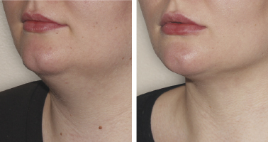 flacidez en la papada