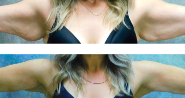 Los mejores consejos para combatir la flacidez