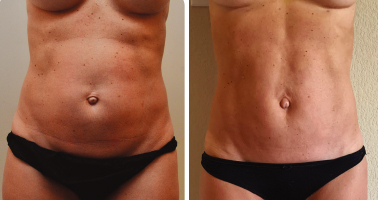 flacidez en el abdomen