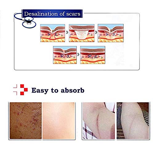 Cicatrices Tratamiento,Cicatrices Serum,Gel Crema para Cicatrices,Aceite para cicatrices,Cicatrices de Acné o Cirugía Nuevas o Antiguas,MejorTratamiento para acné,cicatrices,líneas finas y Arrugas