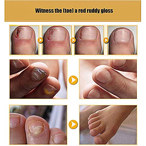 Crema de uñas para pies Crema para el cuidado de la piel Crema de hongos para uñas Crema anti hongos para reparar las uñas