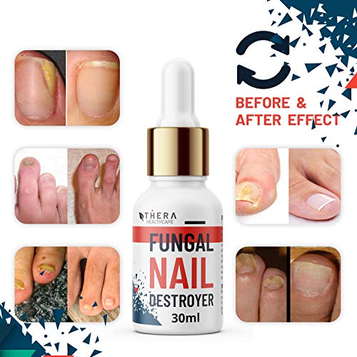 Destructor de hongos de uñas de alta calidad, adecuado para uñas de dedos y dedos de los pies, contiene aceite de argán y aceite de árbol de té, 30 ml, lima de uñas y cepillo de uñas.