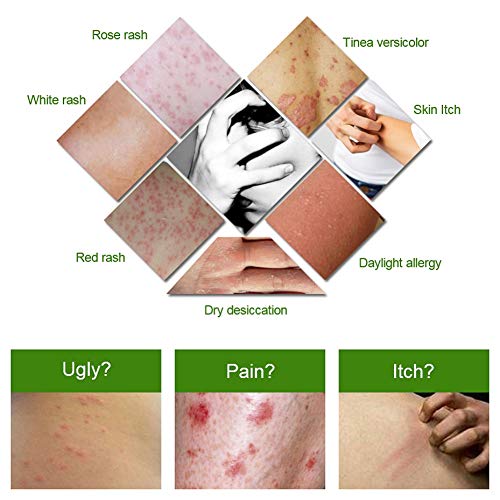 Lucoss Crema para Poriasis Picazón Antibacteriano Ungüento Hierbas Cremas Eczema Psoriasis Peeling