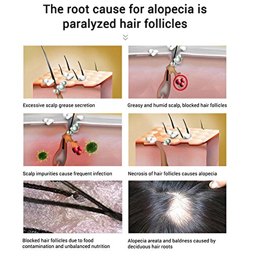 Mounsii Serum para el crecimiento del cabello Aceite esencial Raíz de vellón Raíz denso Cabello Jengibre Extracto Tratamiento contra la pérdida Restauración