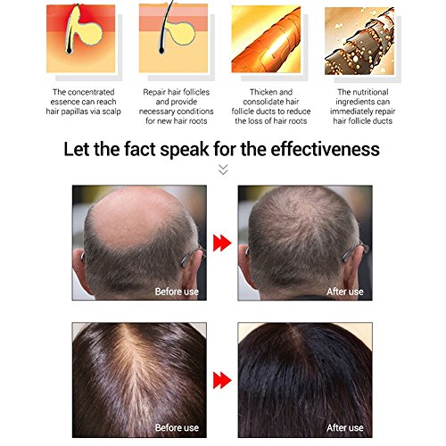 Mounsii Serum para el crecimiento del cabello Aceite esencial Raíz de vellón Raíz denso Cabello Jengibre Extracto Tratamiento contra la pérdida Restauración