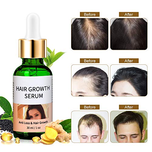 Serum Crecimiento Cabello, Anticaida de Cabello, Para cabello fino, Calvo, Perdida de cabello, Promueve un crecimiento más grueso, Tratamiento para el crecimiento del cabello Para hombres y mujeres