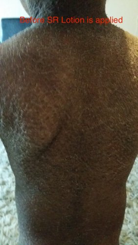 SR Lotion G16 - Crema para tratamiento de la ictiosis (excelente resultados en 2 semanas)