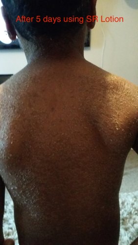 SR Lotion G16 - Crema para tratamiento de la ictiosis (excelente resultados en 2 semanas)