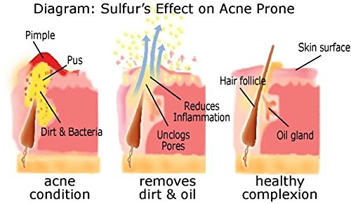 Sulfuro de azufre al 10% para el acné Ingredientes 100% naturales Jabón de azufre Barra limpiadora de jabón Paquete de 3