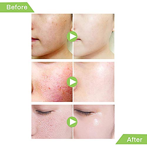 Aceite esencial de árbol de té, Tea Tree Oil,Aceite Esencial de Arbol de Te, Alivia las irritaciones comunes de la piel,la piel seca y agrietada,las cutículas y las espinillas,anti-acné