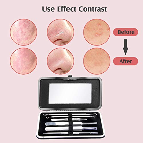 Aguja Extractor Limpiador Blackhead Remover Kit 6PCS Wolady Quitar Punto Negro Aguja Acné Comedón Quita Espinilla Blackhead Extractor Limpiador Acné Herramienta Defecto Acero Inoxidable Caja y Espejo