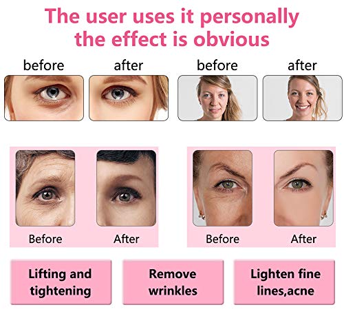 Aozzy Portátil Alta Frecuencia Facial Belleza de Dispositivos para Quitar Arrugas, Acné y Alopecia con 4 Electrodos