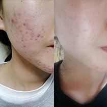 BONAJOUR Extreme oscuro suero reparaciones puntuales las mejores cicatrices de acné reparación clara y abrillantadores y eliminar el acné 1.7fl.oz suero