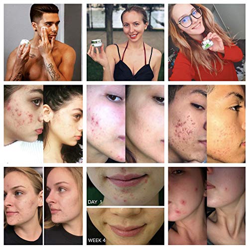 Crema Organica Anti Acne Keeva Organics Tratamiento Anti Acne con Acido Salicilico y Arbol de Té, Reduce Espinillas, Puntos negros y granos.