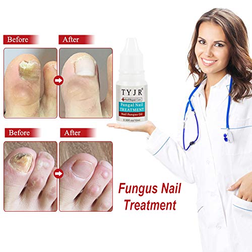 Hongos Uñas Pies,Fungus Stop,Hongo Uñas Tratamiento Anti Hongos De Uñas,Tratamiento Anti Hongos De Uñas Apto Para Dedos y Pedicura
