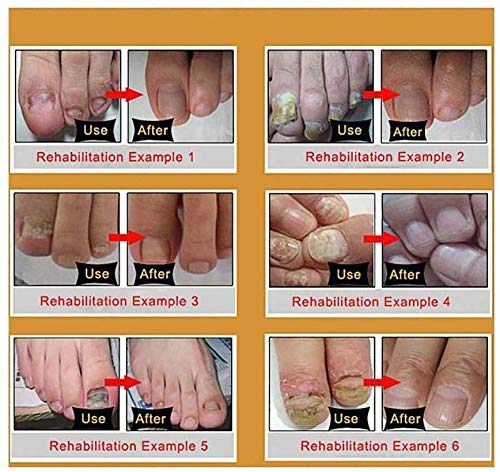 Hongos Uñas,Hongo Uñas Tratamiento,Anti Hongos De Uñas,Tratamiento Contra Hongos e Infecciones de las Uñas,Uñas de los pies y las Uñas Solución