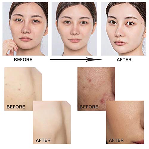 Jabones Facial, Jabón Exfoliante, Acne Jabon, Jabón de hecho a mano, Jabón Natural, Espinilla Poros Remoción Tratamiento para el acné, Poros, Espinillas, Manchas y Piel Grasa