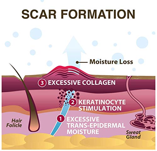 Láminas de silicona EpiDerm Mastopexia (1x2 Unidades/transparente Parches de cicatriz contra Cicatrices en el Mama, de Biodermis