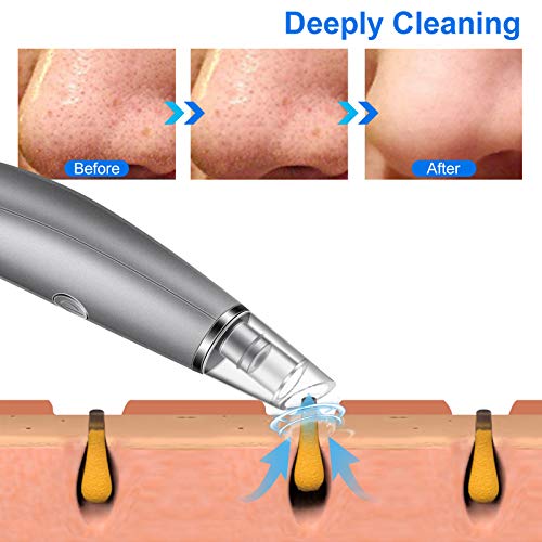 Limpiador de Poros - Extractor Puntos Negros Eléctrico Aspirador de Puntos Negros, Limpor Facial Quita Espinillas, Exfolia la piel muerta Para Tratamiento Facial