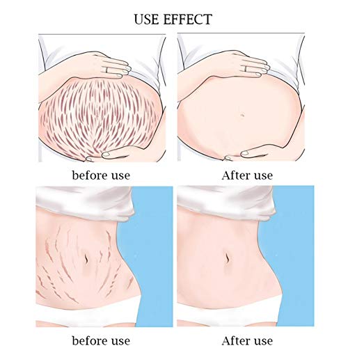 Lucoss Crema Corporal Anti Estrías,Crema Reafirmante Post-parto Reductor Cicatrices Estrías en Embarazo,Corrección Estrías Crema Reafirmante