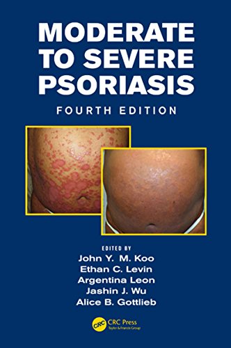 Moderate to Severe Psoriasis (English Edition)