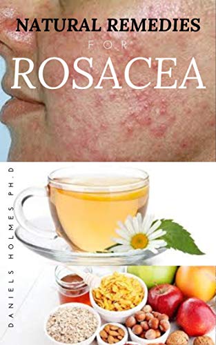 NATURAL REMEDIES FOR ROSACEA: Treating Rosacea with Natural Home Remedies Includes Nose Redness,Acne,Eczema and Lots More (English Edition)