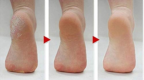 Placehap - Herramienta para el cuidado de pies + 3 piezas de lijado para el cuidado de la piel de pies muertos para exfoliación de pies y cutículas de talón