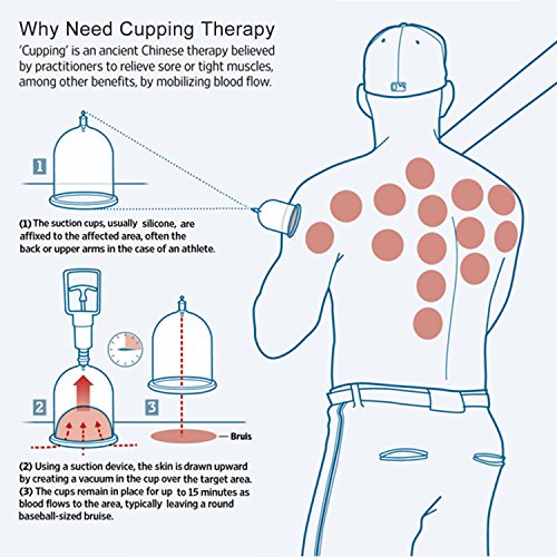 Set Ventosa Cupping Terapia Chinas por DigHealth, 12 Vasos de Aire Vacio y Bomba, Medicina Curacion Tratamiento Caseras para Celulitis, Dolor de Espalda, Facial,Adelgazar, Pies,Estomago,Bajar de Peso