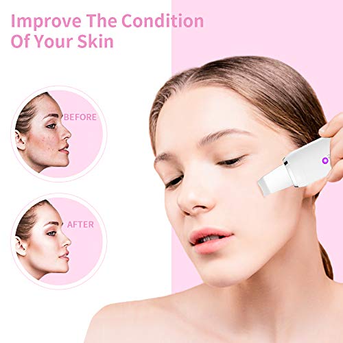 Skin Scrubber - Ubitree Peeling Ultrasónico Facial Removedor de Acné Limpiador de Poros, Lifting Dispositivo de Belleza Facial Para Limpieza Facial y Cuidado Facial