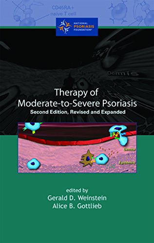 Therapy of Moderate-to-Severe-Psoriasis (English Edition)