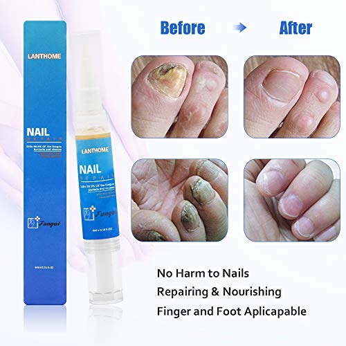 Tratamiento de hongos anti hongos, Tratamiento de hongos anti hongos, Tratamiento de uñas anti hongos líquido para el cuidado de las uñas adecuado para uñas de dedos y pies