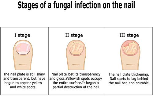 Tratamiento de uñas, hongos pies, antimicóticos, fungus tratamiento crema para los pies, protección contra hongos de las uñas, reparación de uñas