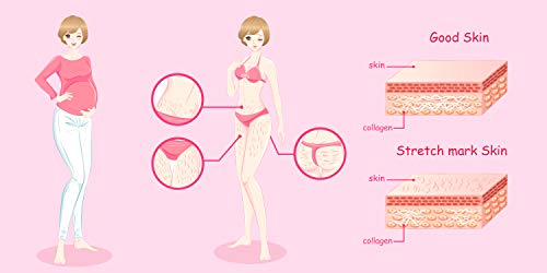 Tratamiento profesional Crema Antiestrías Doble Acción Prevención y Reparadora con Aloe Vera, Vitamina E y Manteca de Karité, formatos ahorro (2 x 200 ml)