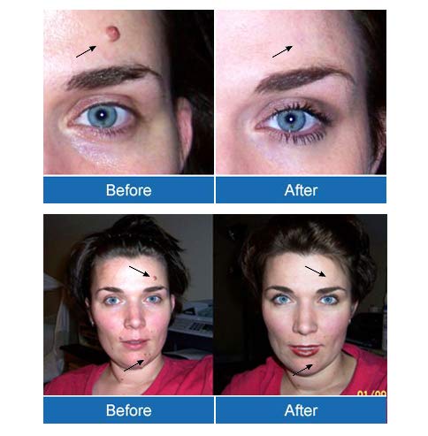 Wart & Mole Vanish - Kit Para Eliminar Verrugas Y Lunares - Elimina Las Verrugas Y Lunares De Forma Natural Y Eficaz - Kit Completo De Eliminación De Todo Tipo De Verrugas