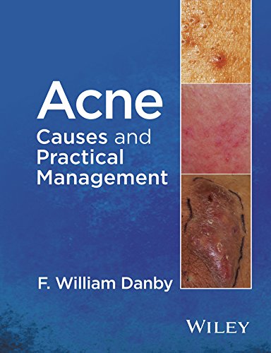 Acne: Causes and Practical Management (English Edition)