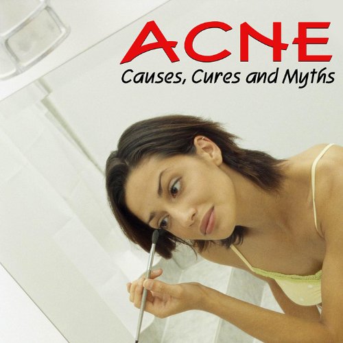 Acne - Causes, Cures, and Myths