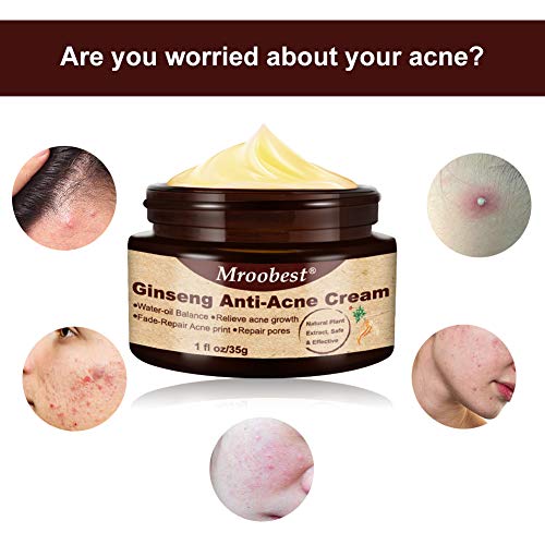 Acné Crema, Crema Antiacne, Acne Cream, Crema Para El Acné Ginseng，Equilibrio de agua y aceite, Crema contra el acné espinilla regenera la piel